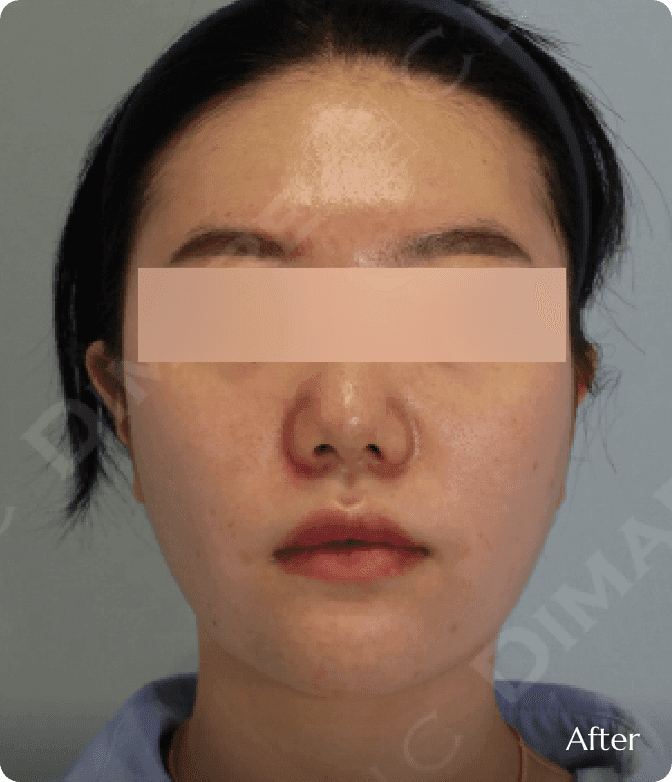 디마레 이중턱지방흡입(매직브이라인) 후, 턱 밑 군살이 정리되어 숨겨져 있던 턱 끝이 선명하게 드러난 V라인 결과