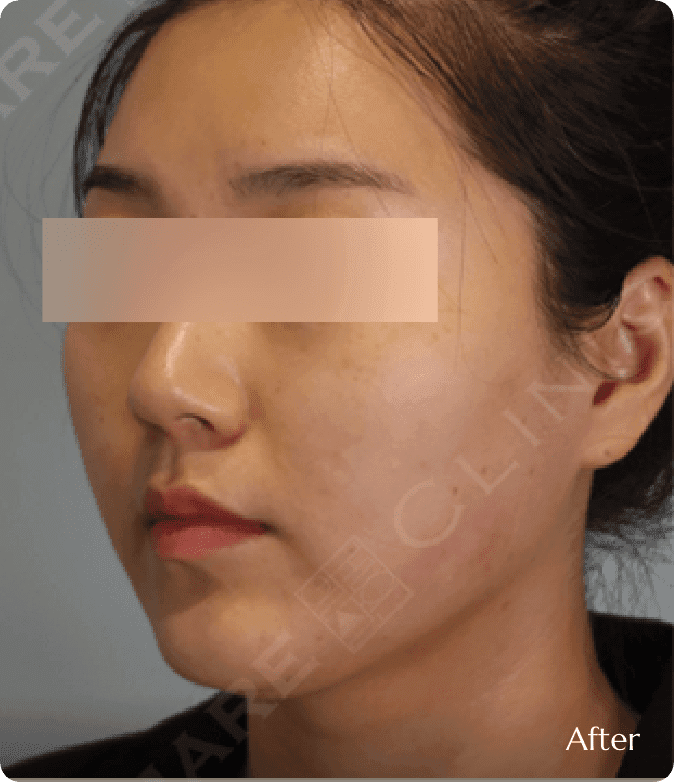 이중턱 제거 및 리프팅 효과, 지방이 빠진 자리에 피부가 밀착되어 얼굴 폭이 좁아지고 날렵해진 턱선 변화