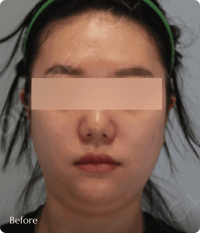 디마레 이중턱지방흡입 전, 턱 밑 지방과 늘어진 살로 인해 얼굴형이 둥글고 턱선이 묻혀 보이는 정면 케이스