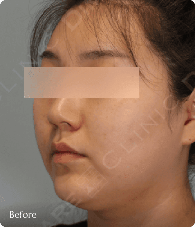 이중턱과 두툼한 하관 지방으로 인해 얼굴과 목의 경계가 불분명하고 인상이 둔탁해 보이는 시술 전 모습