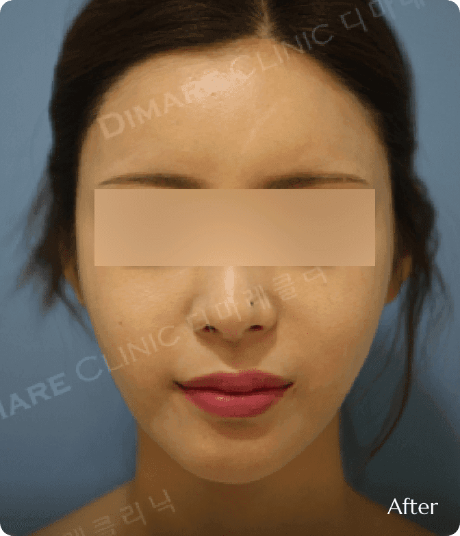 디마레클리닉 얼굴지방흡입 시술 후, 불필요한 지방 제거로 턱선이 드러나고 매끄럽고 갸름해진 V라인 변화 결과