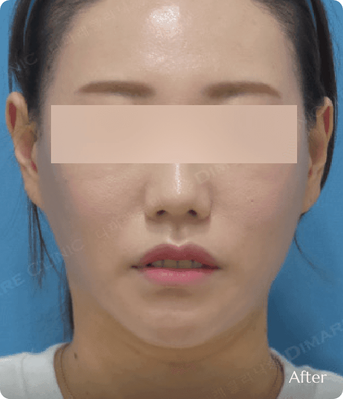 광대 축소 및 얼굴지방흡입 후, 울퉁불퉁했던 얼굴 윤곽이 부드럽게 정리되어 작고 입체적인 얼굴형으로 개선된 모습