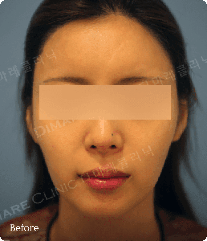 디마레클리닉 얼굴지방흡입 시술 전, 볼살과 턱선 라인이 둥글고 지방이 축적되어 얼굴이 커 보이는 정면 모습