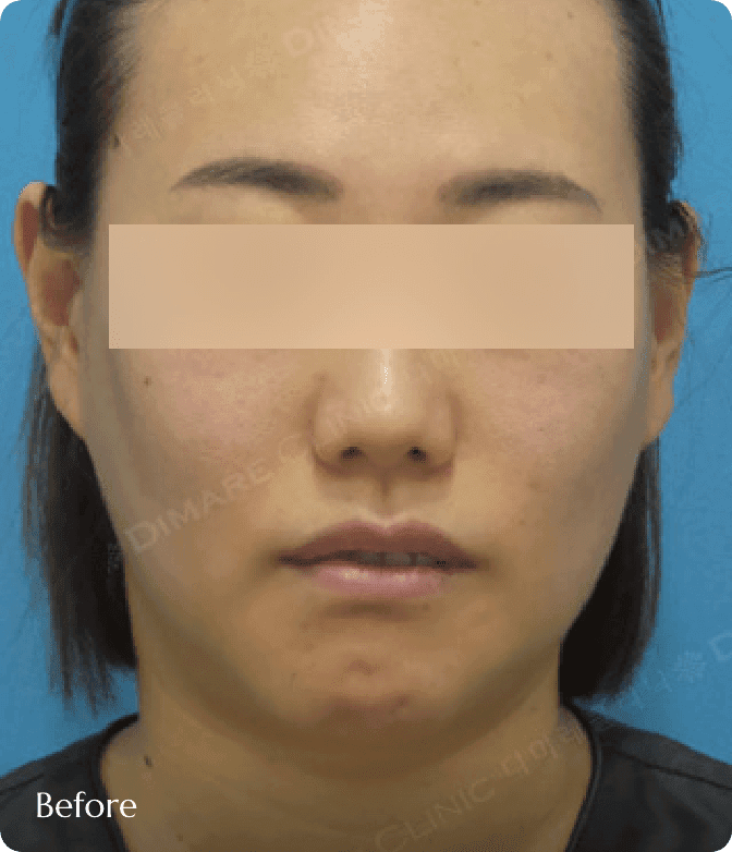 광대 축소 및 얼굴지방흡입 전, 옆광대 돌출과 심부볼 지방으로 인해 얼굴 가로 폭이 넓고 굴곡져 보이는 사례