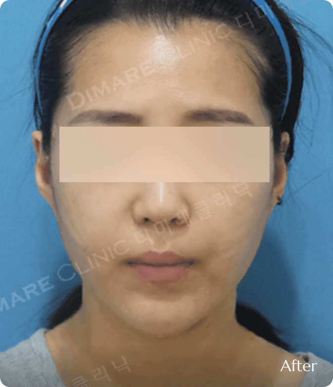 주름 개선 및 동안 리프팅 효과, 처진 피부 조직을 강하게 끌어올려 팔자주름이 옅어지고 앞볼의 볼륨 위치가 높아진 생기 있는 결과