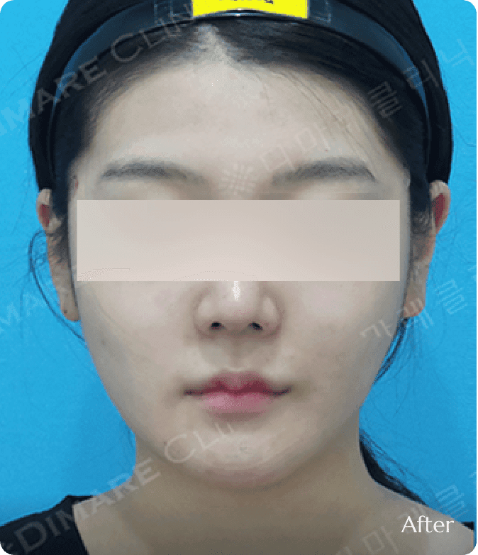디마레 파워 리프팅 결과, 늘어진 불독살과 턱 밑 살이 탄력 있게 밀착되어 울퉁불퉁했던 윤곽이 매끄럽고 선명한 V라인으로 변화