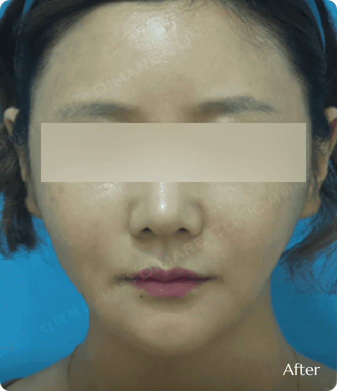 광대 축소 및 얼굴지방흡입 후, 울퉁불퉁했던 얼굴 윤곽이 부드럽게 정리되어 작고 입체적인 얼굴형으로 개선된 모습