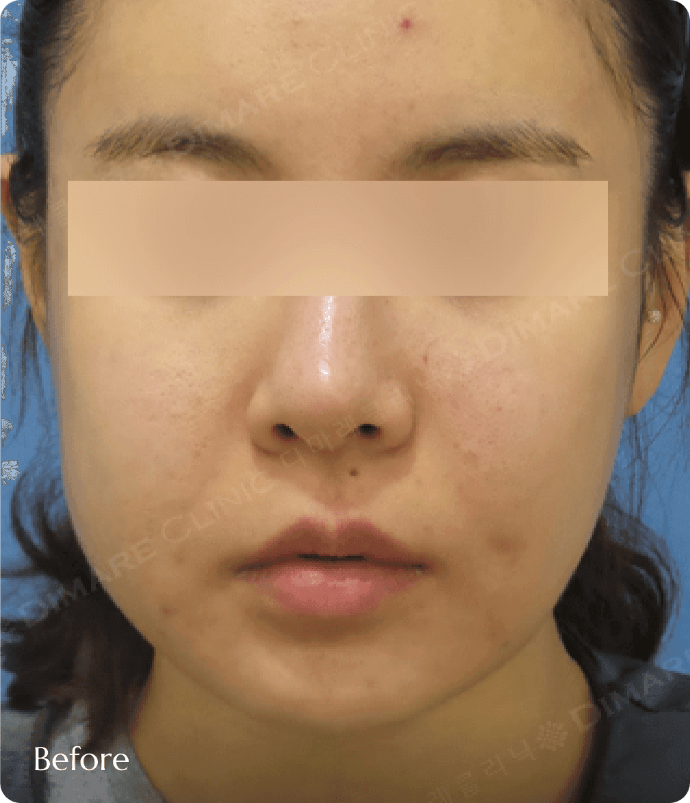 디마레클리닉 얼굴지방흡입 시술 전, 볼살과 턱선 라인이 둥글고 지방이 축적되어 얼굴이 커 보이는 정면 모습