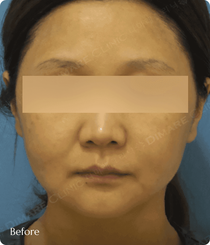 광대 축소 및 얼굴지방흡입 전, 옆광대 돌출과 심부볼 지방으로 인해 얼굴 가로 폭이 넓고 굴곡져 보이는 사례