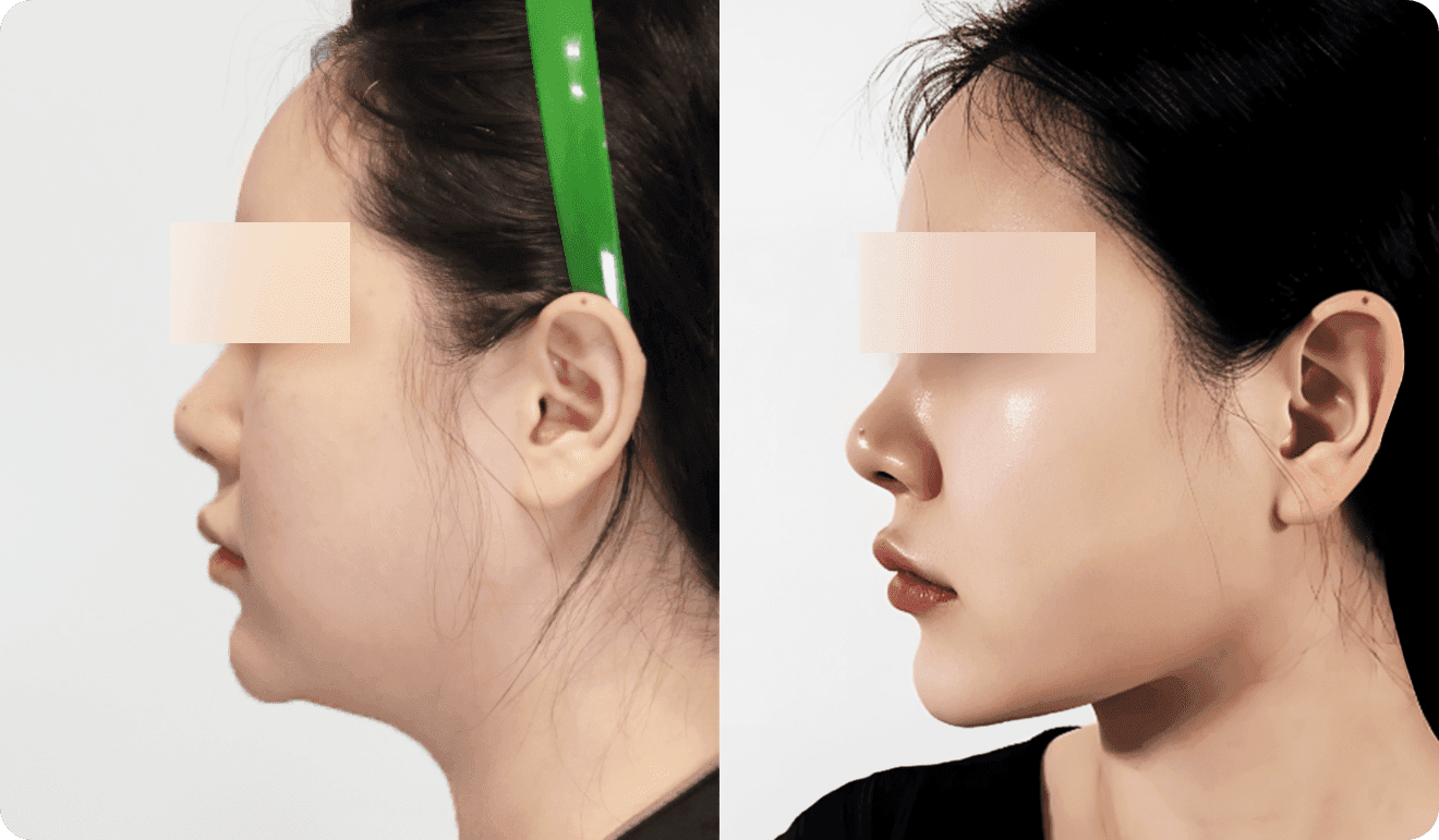 디마레 이중턱 지방흡입 전후, 둔탁했던 턱 밑 지방이 제거되어 날렵하고 선명해진 턱선 변화