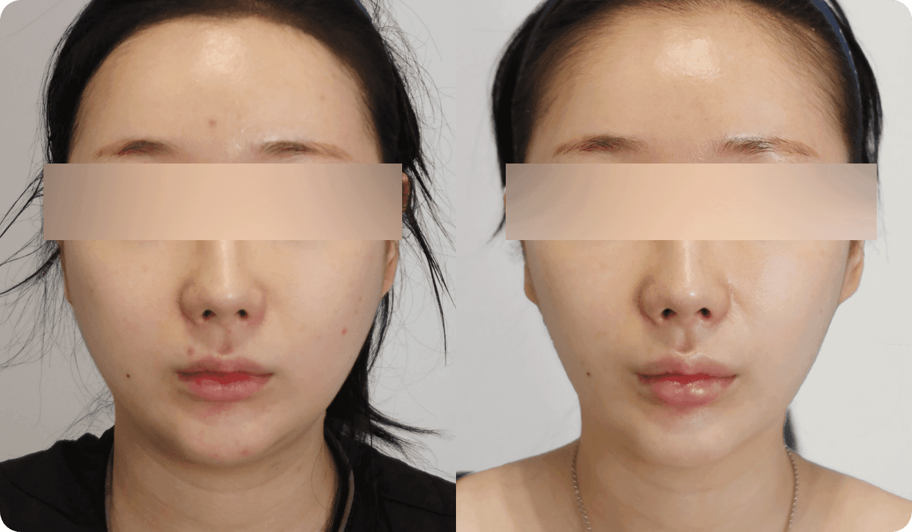 디마레 매직광대 시술 전후, 도드라진 옆광대와 볼살을 정리하여 부드러워진 얼굴 윤곽 라인