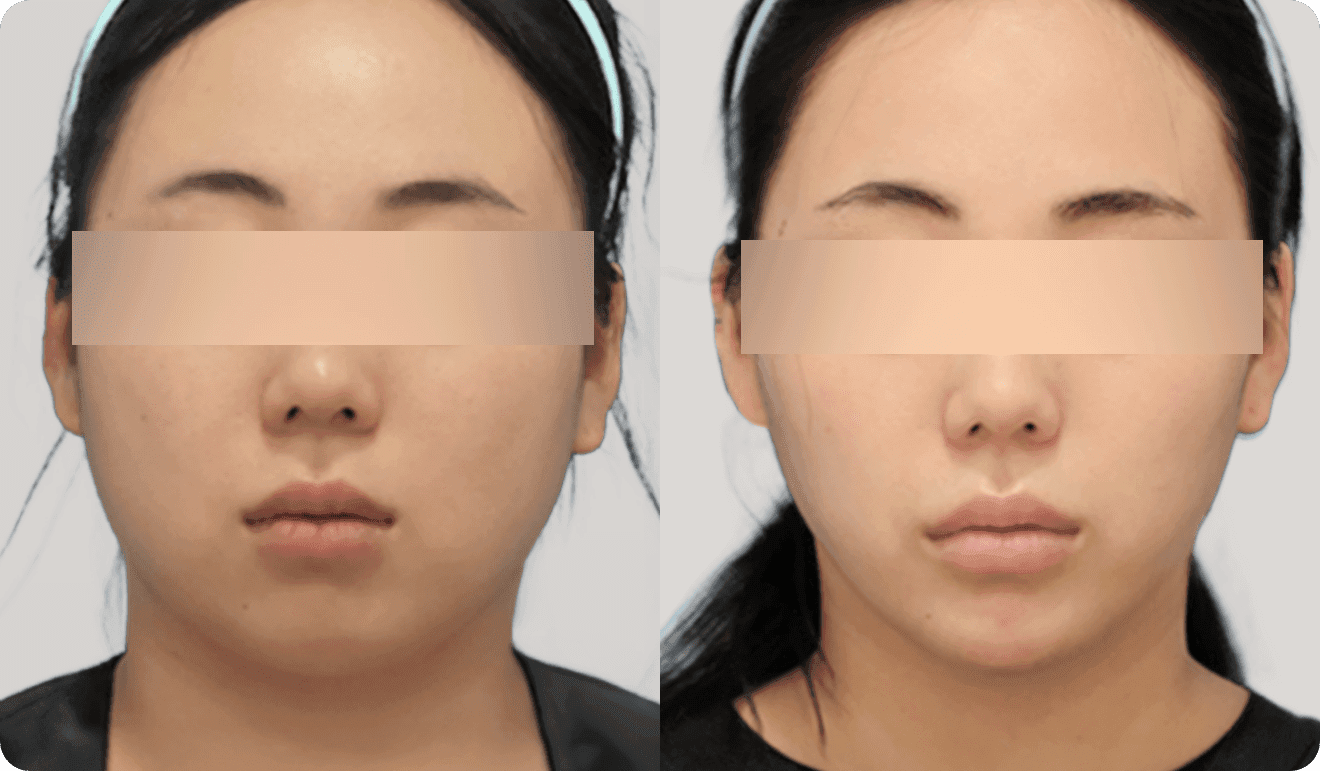 디마레 심술보 지방흡입 전후, 처진 입가 살과 불독살을 개선하여 매끄럽게 정돈된 하관
