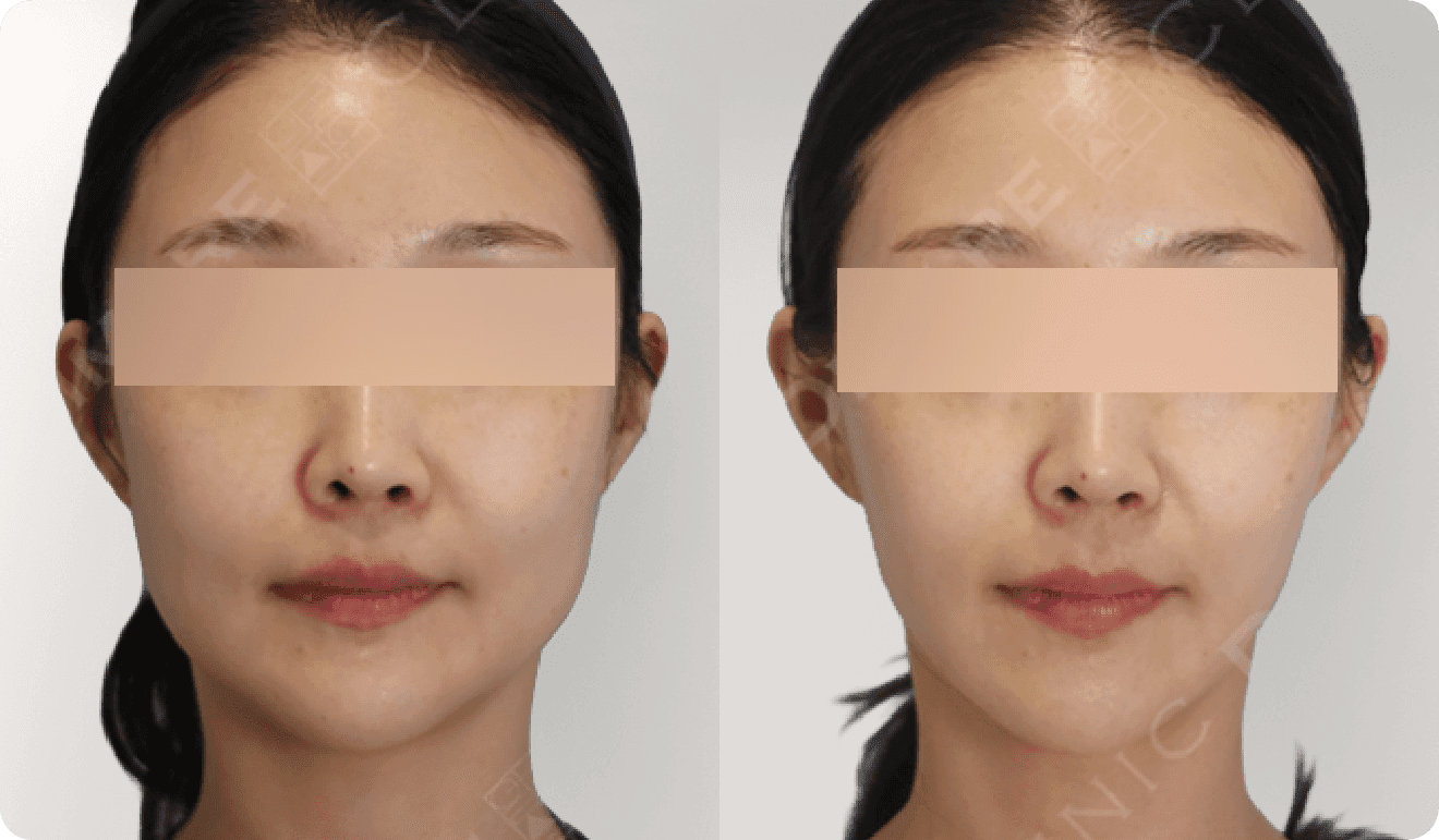 디마레 얼굴지방흡입 전체 전후, 넓어 보이던 얼굴 여백을 줄이고 입체감을 살린 작은 얼굴 효과