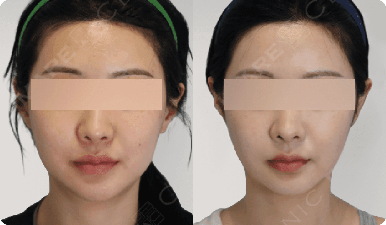 디마레 얼굴지방이식 전후, 꺼진 부위에 자연스러운 볼륨을 채워 생기 있고 어려 보이는 얼굴 변화