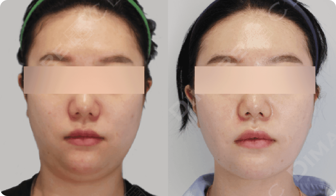 디마레 1:1 맞춤 얼굴 디자인 전후, 인위적이지 않고 자연스럽게 개선된 얼굴형 시술 사례