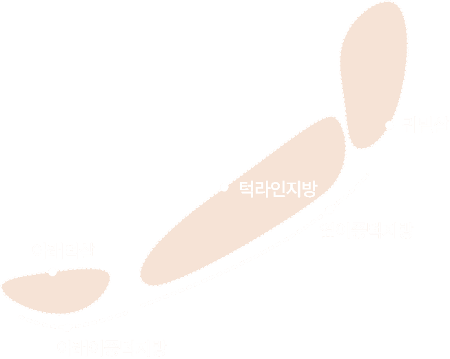 디마레클리닉 얼굴지방흡입·지방이식 메인 배너, 관자·광대·팔자·심술보·턱선·이중턱 등 부위별 얼굴 지방 분석도를 표시한 이미지