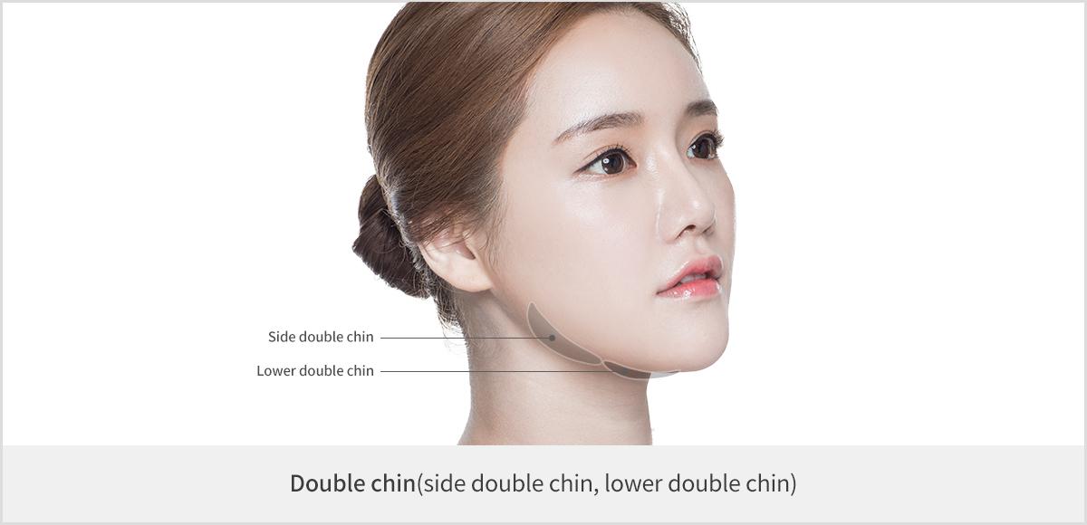 Chin Liposuction