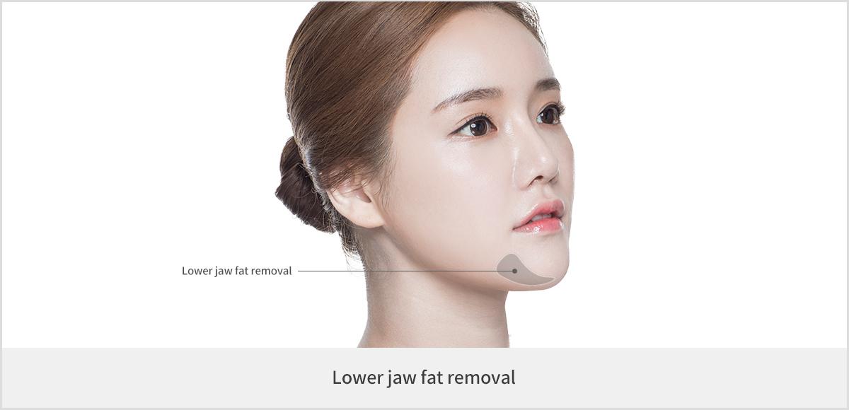 Chin Liposuction