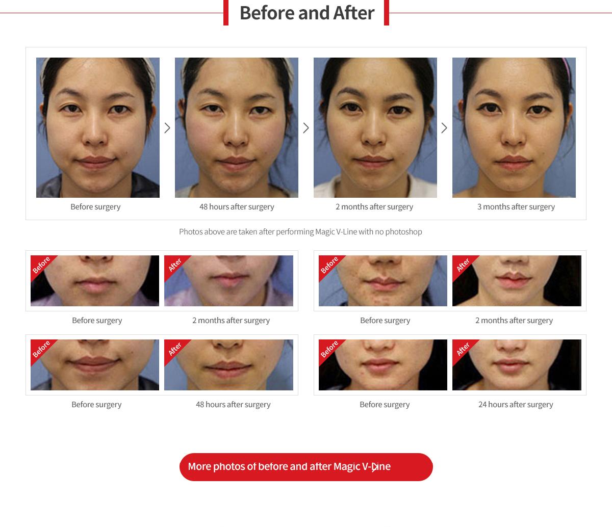 Chin Liposuction