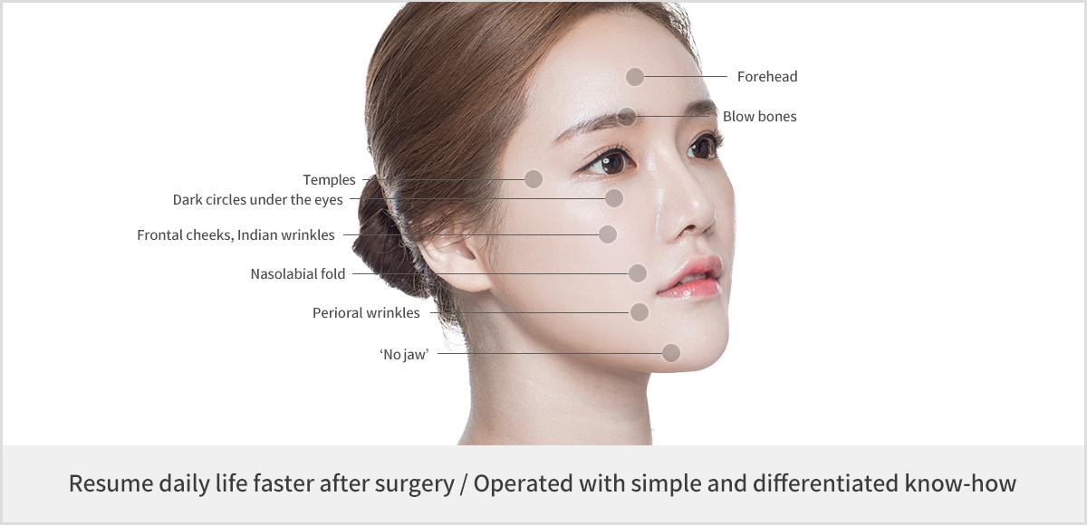 Facial Fat Grafting