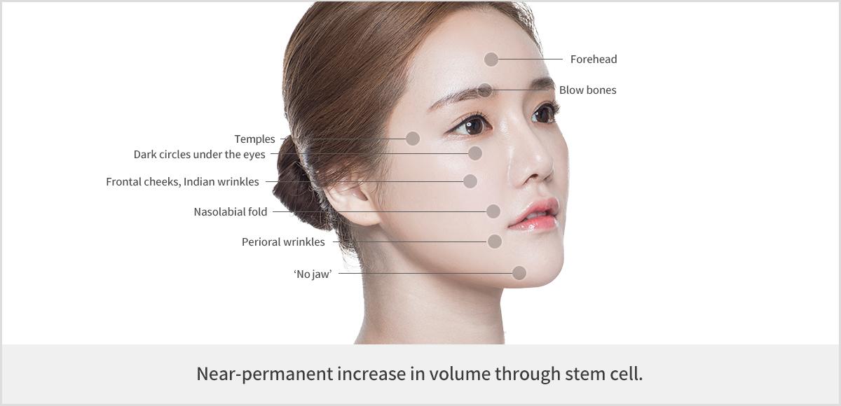 Facial Fat Grafting