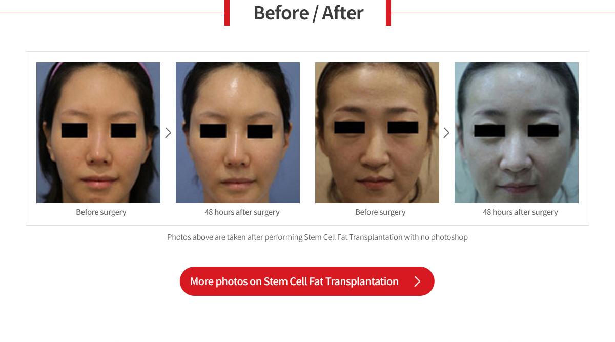 Facial Fat Grafting