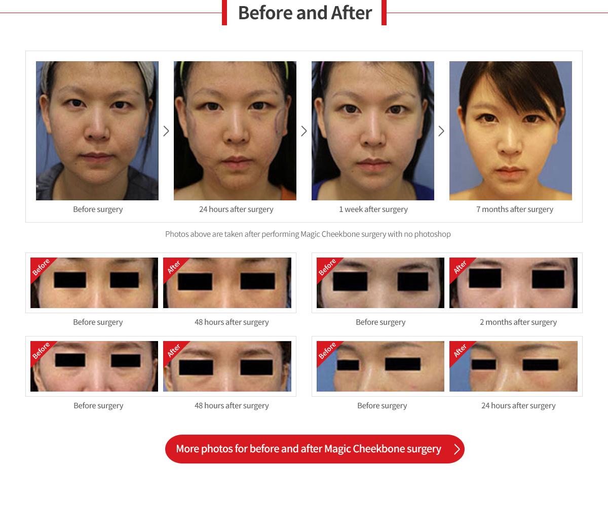 Facial Liposuction
