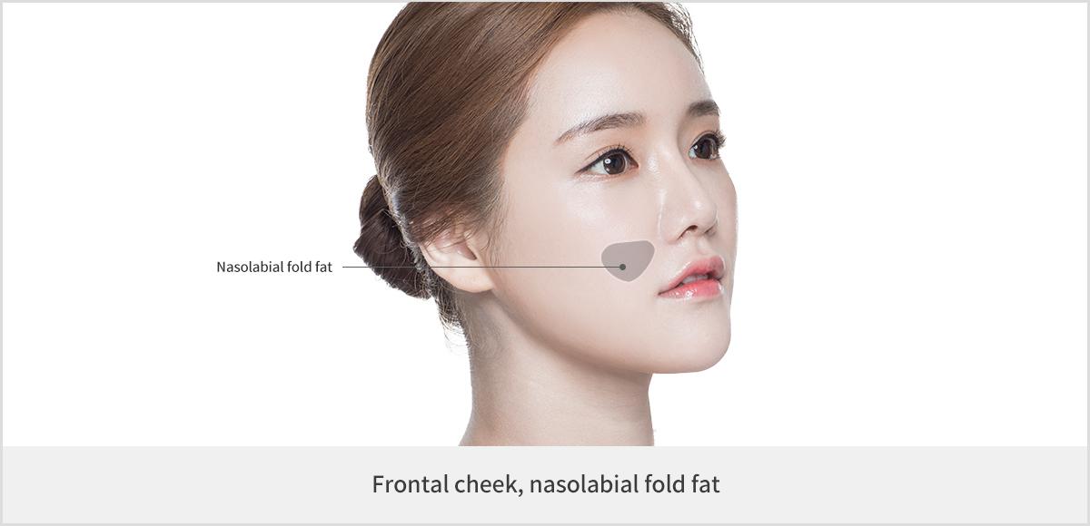 Facial Liposuction