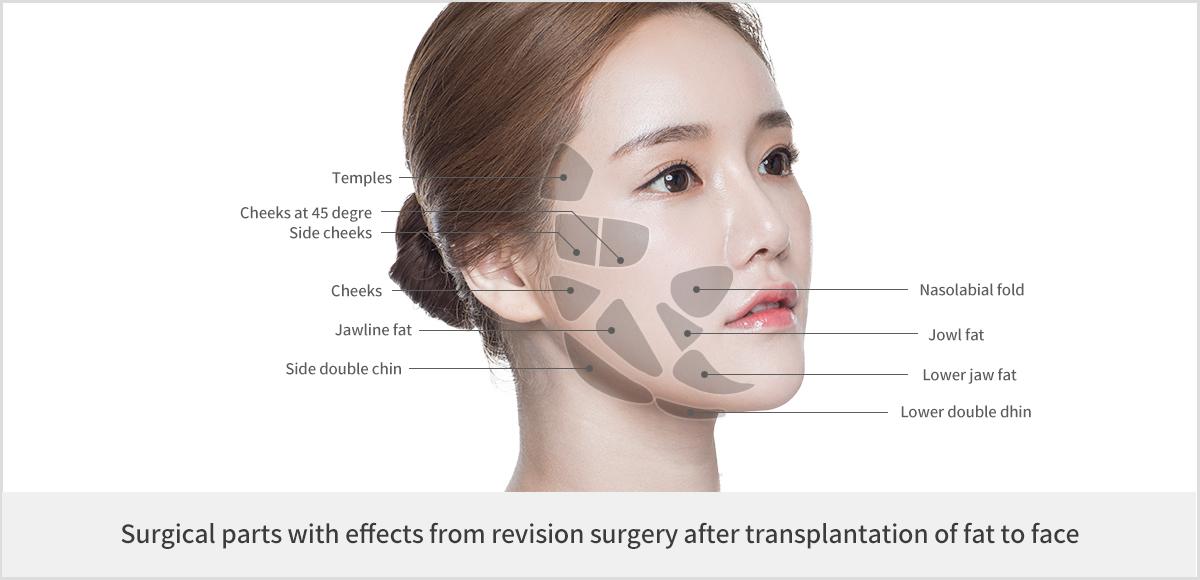 Revision Surgery