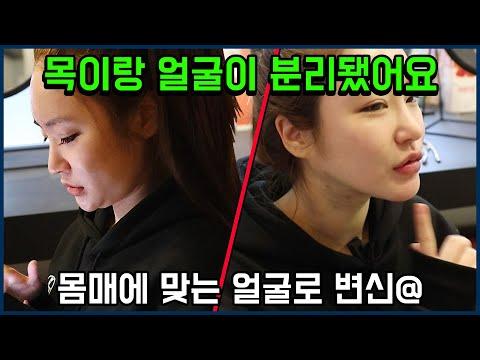 이중턱 지방흡입으로 목이랑 얼굴이 분리 됐어요!!