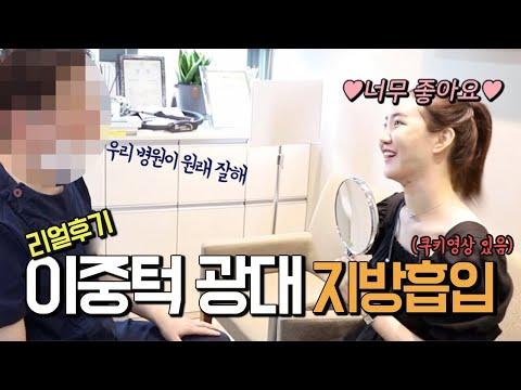 말을 잇지 못하는 얼굴 지방흡입 결과