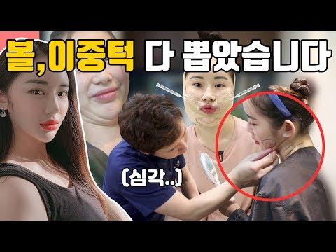 희정님의 '이중턱 지방흡입' 브이로그
