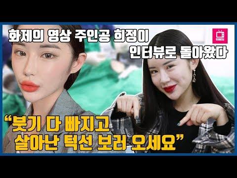 “얼굴지방흡입 궁금해?” 붓기 다 빠진 이중턱 지방흡입 후기 3탄! 이중턱, 볼살, 턱살 얼굴지방흡입 통증, 관리, 부작용 인터뷰 