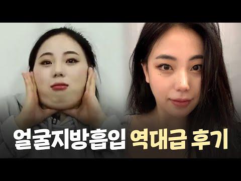 얼굴지방흡입 역대급 후기