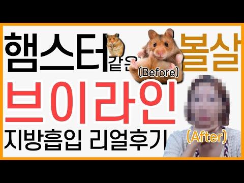 햄스터같던 볼살 지방흡입