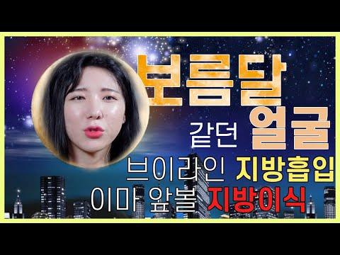 보름달같은 얼굴이 이제 과거의 얼굴! 지방흡입으로 달라진 그녀의 얼굴
