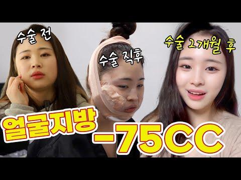 얼굴에 있는 지방 다 빼고왔어요