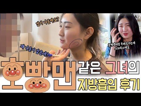 호빵같은 얼굴 지방흡입으로 해결했어요