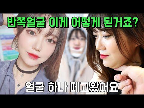 이중턱 지방흡입으로 제거가 가능해?