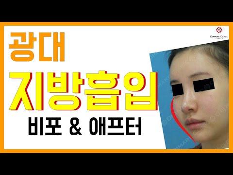 매직 광대 비포 & 애프터