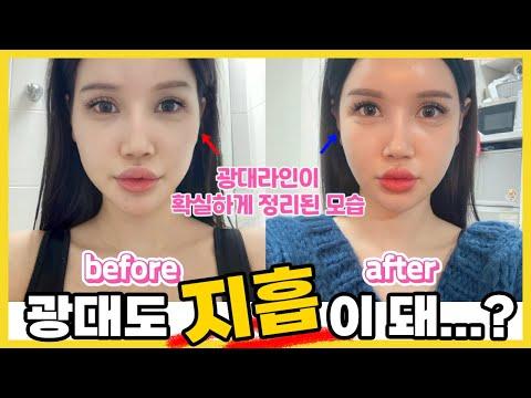 광대지방흡입이 돼...?