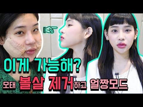 얼굴지방흡입 후기 2탄!