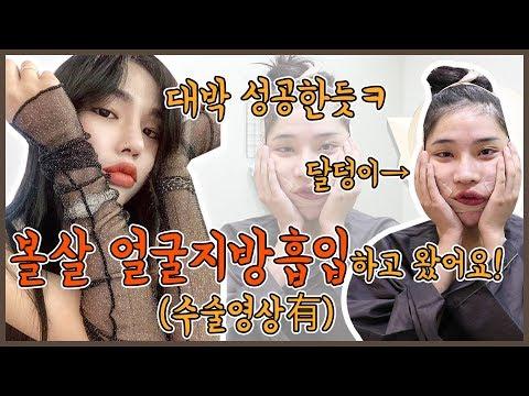 하윤님의 볼살지방흡입/안면비대칭해결 브이로그!