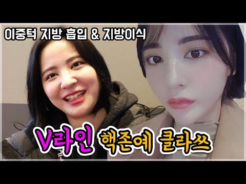 이중턱 지방흡입&지방이식하고 새로 태어났어요✨10kg을 빼도 안빠졌던 턱살 한번에 해결한 생생 직캠