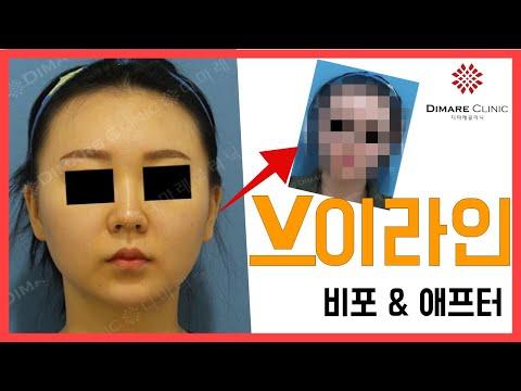 매직브이라인 비포 & 애프터