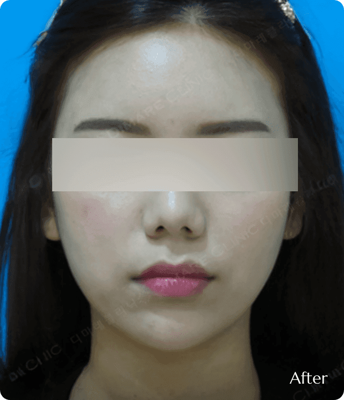 디마레 얼굴지방이식 후, 꺼진 부위가 매끄럽게 채워져 얼굴의 S라인 입체감이 살아나고 또렷해진 윤곽 변화