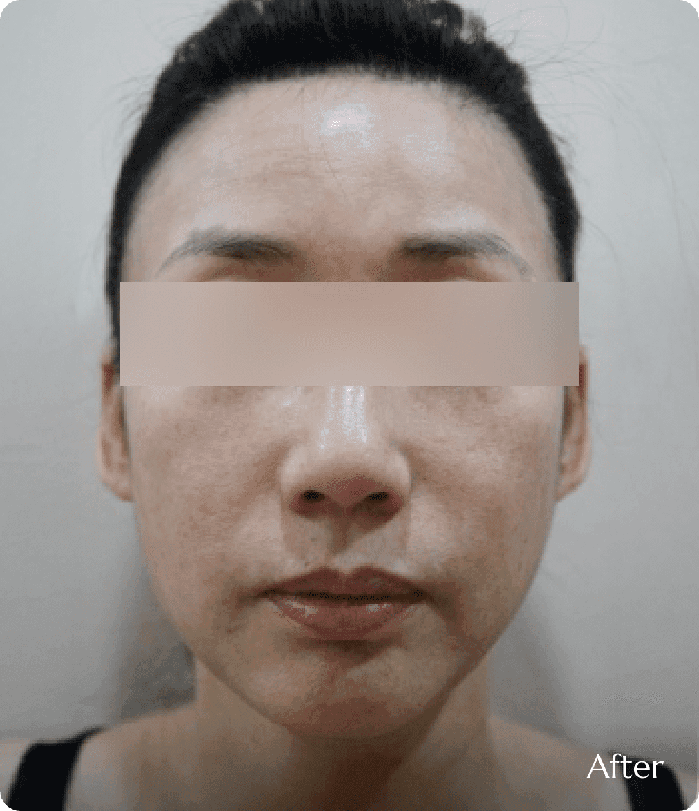 풀페이스 지방이식 결과, 얼굴의 굴곡진 라인이 부드럽게 연결되고 피부에 자연스러운 생기가 도는 동안 이미지 완성