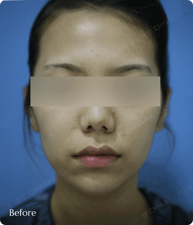 디마레 얼굴지방이식 전, 이마와 앞볼의 볼륨 부족으로 인해 얼굴 전체가 밋밋하고 평면적으로 보이는 상태