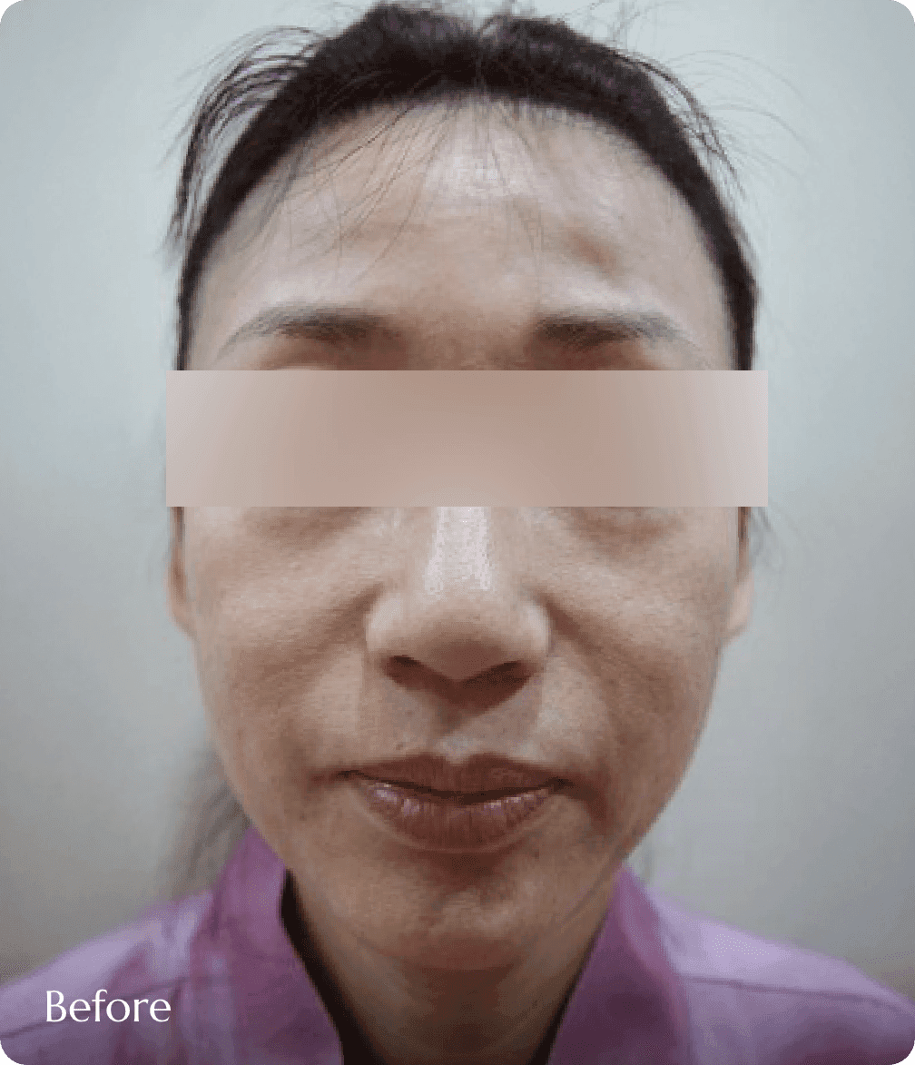 얼굴 살 빠짐으로 인한 노안 고민, 관자놀이와 볼 패임으로 얼굴 라인이 울퉁불퉁하고 피곤해 보이는 시술 전 모습