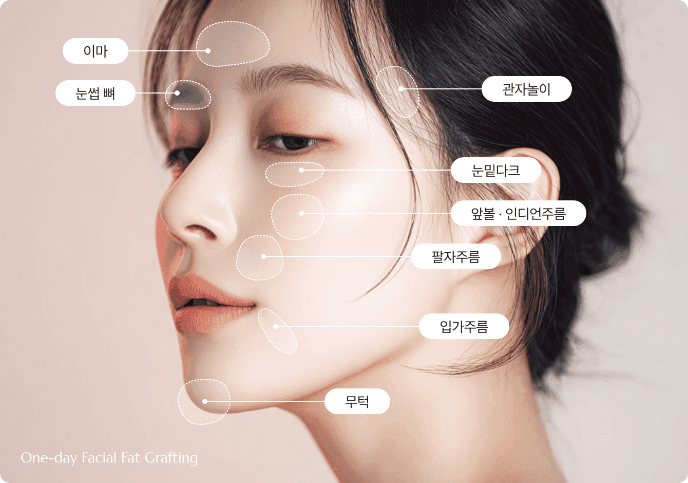 디마레 원데이(1day) 얼굴지방이식 시술 부위, 이마·관자놀이·눈밑·앞볼·팔자주름·무턱 등 꺼진 볼륨을 채워 입체적인 윤곽을 완성하는 디자인 포인트 설명